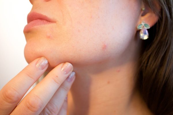 Are Chemical Peels Good for Acne? featured image